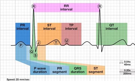 bazzet|QT Interval • LITFL • ECG Library Basics